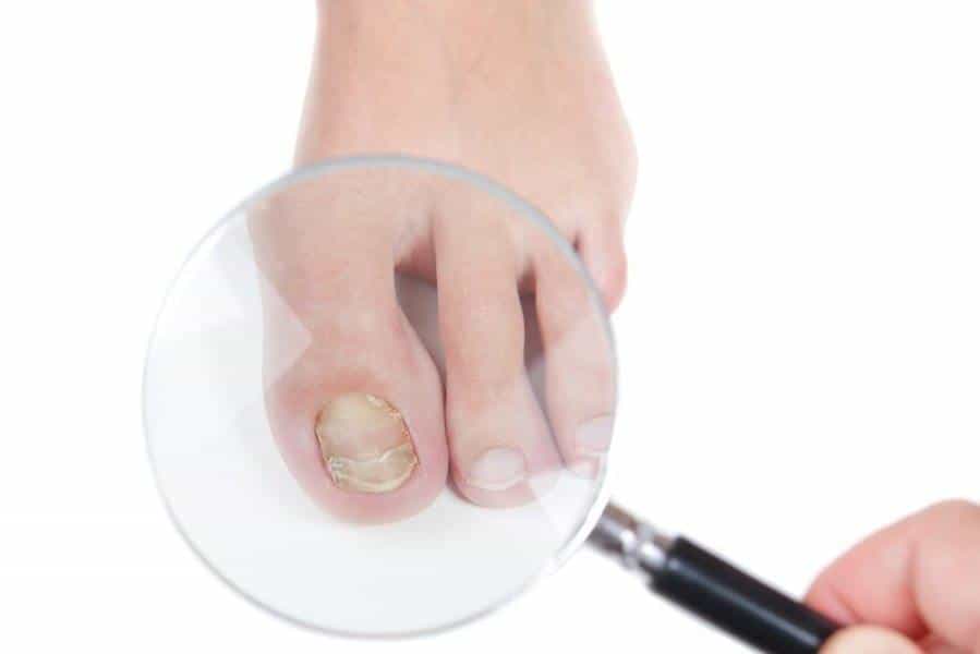 Народные средства лечения грибка ногтей