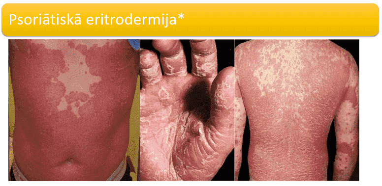 psoriatiska eritrodermija