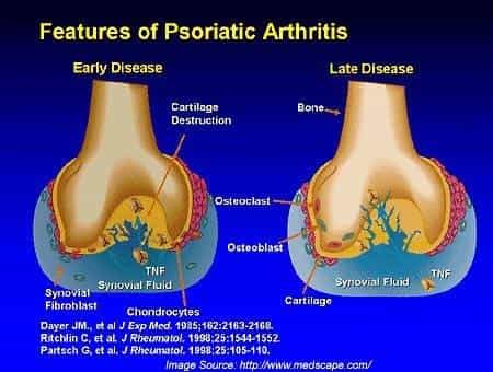 Psoriātiskā artrīta attīstības īpatnības