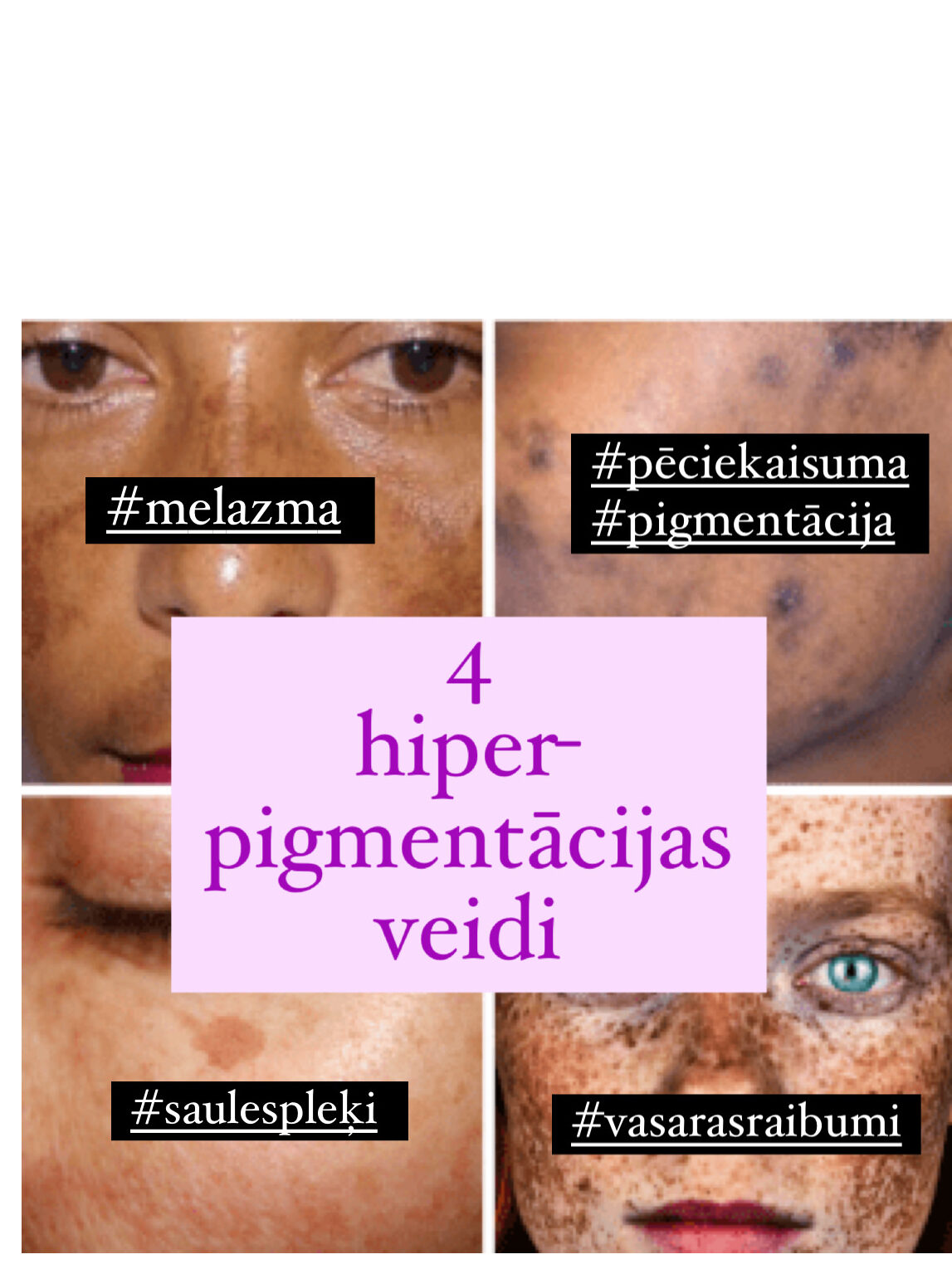 pigmentācijas veidi